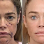 Denise Richards Blasts Open the Facelift Disclosure Taboo with Unfiltered Before-and-After Photos