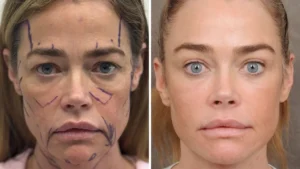 Denise Richards Blasts Open the Facelift Disclosure Taboo with Unfiltered Before-and-After Photos