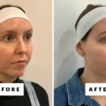 The Future of Facial Rejuvenation: Understanding XERF’s Dual-Frequency Radiofrequency Technology