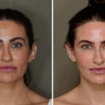The Transformative Power of Fat Grafting: A Natural Approach to Facial Rejuvenation