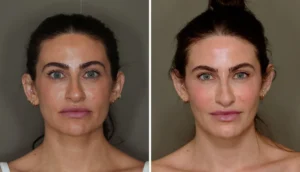 The Transformative Power of Fat Grafting: A Natural Approach to Facial Rejuvenation