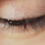 The Tiny Terrors Lurking on Your Eyelashes: Understanding and Managing Demodex Mites