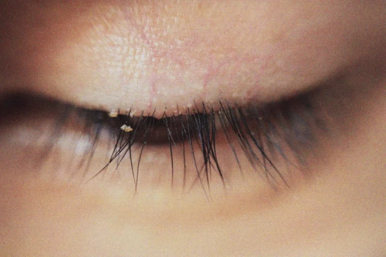 The Tiny Terrors Lurking on Your Eyelashes: Understanding and Managing Demodex Mites