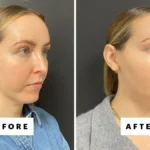 The Unveiling of a Defined Profile: How Chin Fillers Reshaped One Beauty Editor’s Perspective