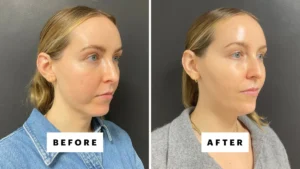 The Unveiling of a Defined Profile: How Chin Fillers Reshaped One Beauty Editor’s Perspective