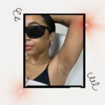 Laser Hair Removal for Melanin-Rich Skin: A Comprehensive Guide to Safety and Efficacy