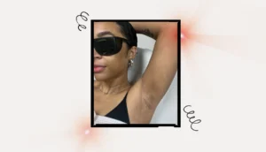 Laser Hair Removal for Melanin-Rich Skin: A Comprehensive Guide to Safety and Efficacy