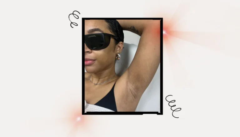 Laser Hair Removal for Melanin-Rich Skin: A Comprehensive Guide to Safety and Efficacy