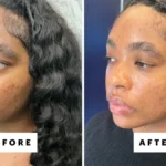 Laser Genesis: A Breakthrough in Dermatological Treatments for Melanin-Rich Skin