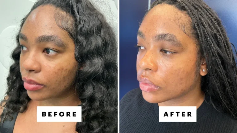 Laser Genesis: A Breakthrough in Dermatological Treatments for Melanin-Rich Skin