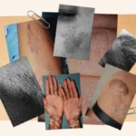 Understanding and Treating Skin Conditions on Melanin-Rich Skin