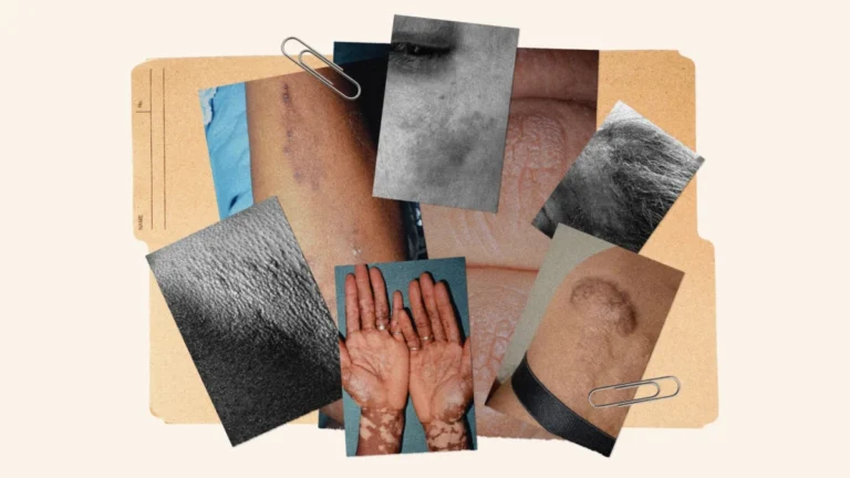 Understanding and Treating Skin Conditions on Melanin-Rich Skin