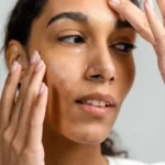 Managing the Dual Burden of Eczema and Milia: A Clinical Guide to Balancing Skin Health